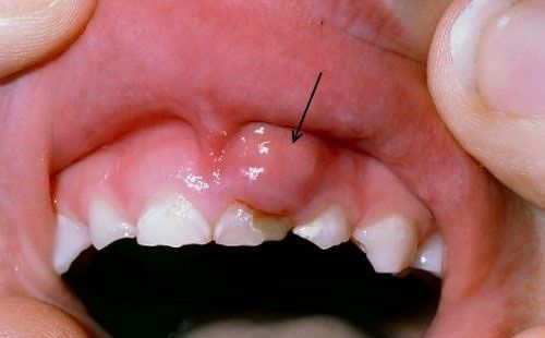 Một số bệnh về răng miệng và cách điều trị