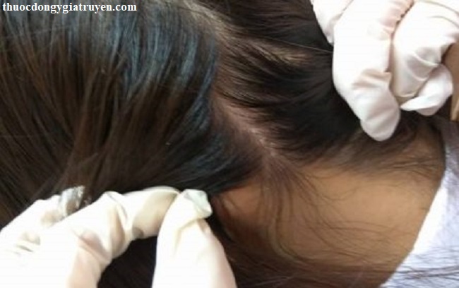 Dấu hiệu nấm da đầu & phương pháp điều trị bằng đông y của lương y Hồng Sơn