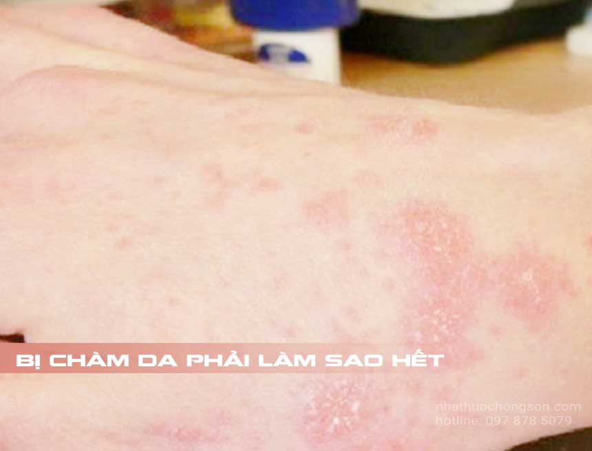 Bị chàm da phải làm sao hết - Bệnh chàm xuất hiện ở vùng da tay