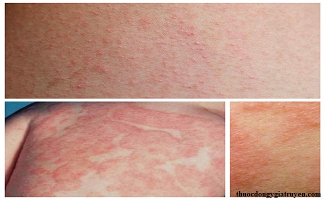 Nguyên nhân và thuốc đặc trị nấm Eczema