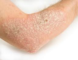 Các bệnh nấm ngoài da hay gặp