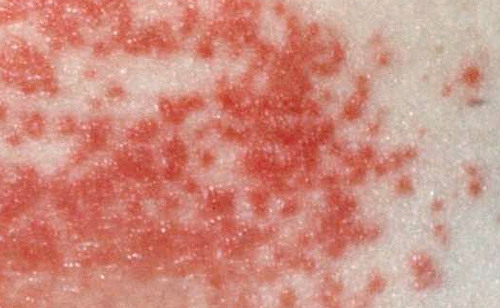 Nguyên nhân, triệu chứng và cách điều trị bệnh nấm da