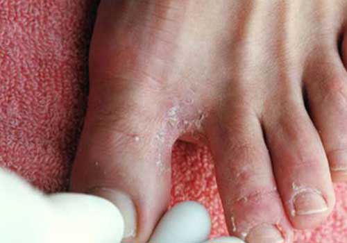 Bệnh nấm da và cách điều trị