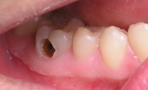 Một số bệnh về răng miệng và cách điều trị