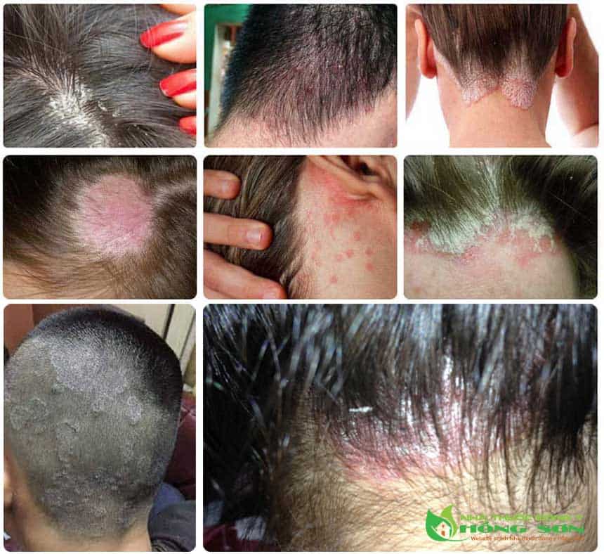 Hình ảnh trước điều trị tổn thương do nấm da đầu