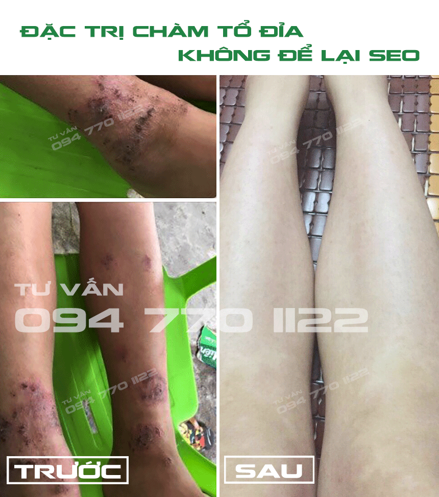 Hình ảnh trước và sau điều trị bệnh chàm tổ đỉa bằng thuốc đặc trị nấm da Hồng Sơn
